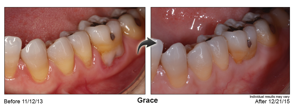 Fort Lauderdale Dentist performs chao pinhole